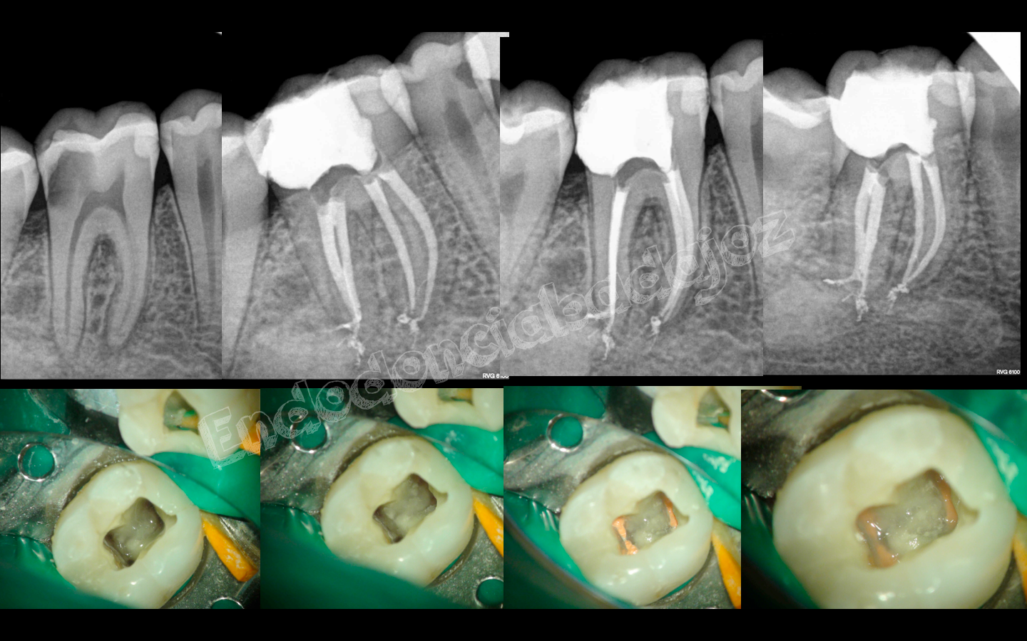 2 molar superior conductos